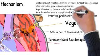 Infective Endocarditis  simply explained Symptoms signs causes [upl. by Doll]