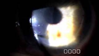 Slit Lamp Techniques  Corneal Epithelium [upl. by Kimmel182]