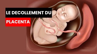 LE DECOLLEMENT DU PLACENTA placenta sensibilisation conseils santé hematomeretroplacentaire [upl. by Teresina]