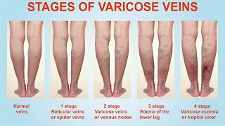 Stages of Varicose Veins [upl. by Karylin322]