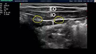 ILIOINGUINAL AND ILIOHYPOGASTRIC BLOCKS [upl. by Tnomyar]