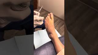 Ingrown toenail procedure Part 1 local anesthesia [upl. by Bashemeth432]