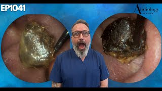 The Most Shocking Ear Wax Removal Youve Never Seen  EP1041 [upl. by Tristam]