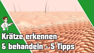 Krätze erkennen und behandeln  Top 5 Tipps 📌 [upl. by Einnaj937]