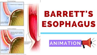 Barretts Esophagus  Pathology Dysplasia and Carcinoma [upl. by Ainafetse]