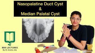 Nasopalatine Duct Cyst amp Median Palatal Cyst Lecture 15 Cysts of Orofacial Region ORAL PATHOLOGY [upl. by Yecnuahc]