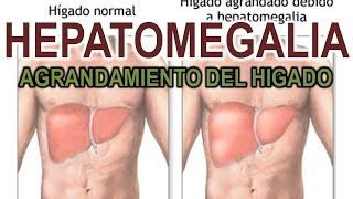 HEPATOMEGALIA  AGRANDAMIENTO DEL HIGADO [upl. by Clyte]