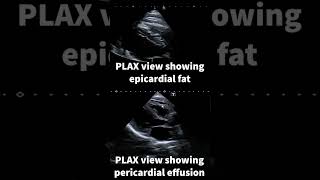 Epicardial fat [upl. by Adella]