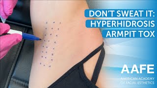 Dont Sweat It Hyperhidrosis Armpit Tox [upl. by Nellahs]