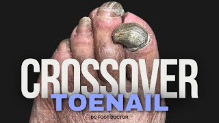 Crossover Toenail Trimming Thick Fungal Toenails [upl. by Jeff143]