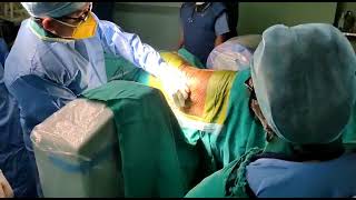 Intrathecal MorphineBaclofen Pump Implantation [upl. by Aurel485]