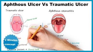 Aphthous ulcerstomatitis Vs Traumatic ulcer [upl. by Ambros199]