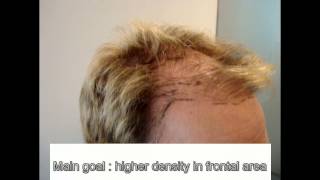 Bad hair transplantation fixed in Belgium [upl. by Llerrad]