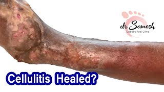 cellulitis infection  Necrotizing Fascitis Healing Stages [upl. by Labannah]