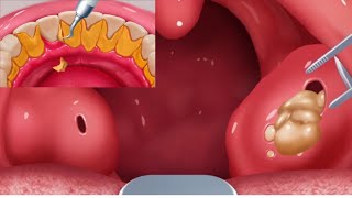 ASMR  Tartar amp Tonsil Stone Removal  Mouth Animation ASMR [upl. by Jamill]