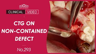 Upper Anterior Immediate Implant placement amp loading Dr Kim Jaeyoon [upl. by Aratal970]