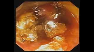 Direct Peroral Cholangioscopy with Electrohydraulic Lithotripsy for Cystic Duct Stone [upl. by Einatsed399]