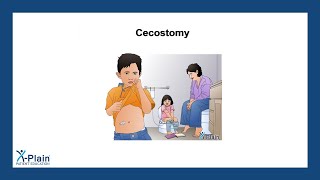 Cecostomy [upl. by Aivatnahs]