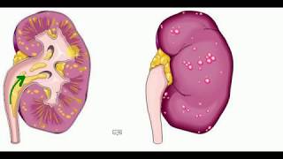 PATHOLOGY LECTURES  Kidney  PYELONEPHRITIS [upl. by Enomys157]