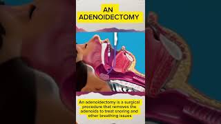 quotAdenoidectomy Explained How Removing Adenoids Can Help Stop Snoring and Improve Breathingquot [upl. by Sikata]