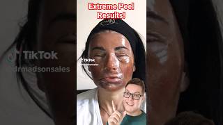 THIS IS CRAZY  Extreme Phenol Peel For Acne Scarring [upl. by Nosirb]