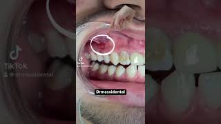 Dental infection  fistula [upl. by Chenee]