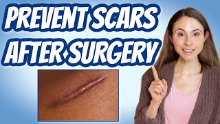 HOW TO PREVENT SCARS AFTER SURGERY 💉 DERMATOLOGIST DrDrayzday [upl. by Watanabe]