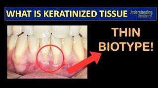 Gingival Recession Treatment How to Check the Keratinized Gingival Tissue Periodontal Maintenance [upl. by Romeu]