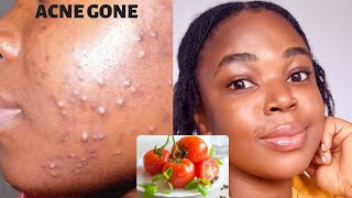 GET RID OF ACNE IN 5 DAYS WITH TOMATOES FACE MASKSHOCKING RESULT tomatoesfacemask acnetreatment [upl. by Calypso]