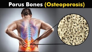 What happens in Osteoporosis  animation [upl. by Naamann]