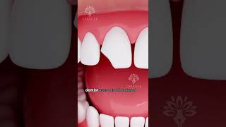 How Does Bonding Fix a Chipped Tooth shorts tooth  Creativelearning3d [upl. by Lubbock589]