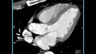 Cardiac evaluation of the coronary arteries 9 of 10 [upl. by Evars840]