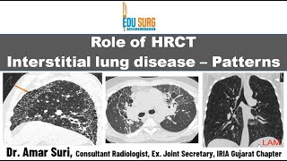 HRCT chest in interstitial lung disease  Chest radiography basics  Classification amp patterns [upl. by Basilius]