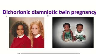 Anatomy of dichorionic and diamniotic twin pregnancy with sonographic feature twin obimagesnet [upl. by Silbahc]