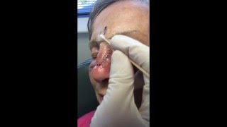 Cleaning Facial Stiches [upl. by Artined]