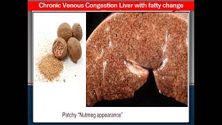 Bilharziasis UB Chronic venous congestion liver fatty change  Chronic rheumatic valvulitis [upl. by Cimbura]