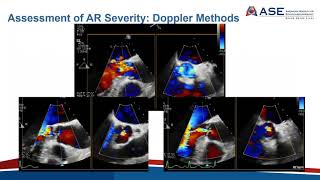 Joint Echo Conference Aortic Insufficiency [upl. by Marmawke]