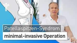 Patellaspitzensyndrom OP Knieschmerzen loswerden durch Operation des JumpersKnee [upl. by Laamak]