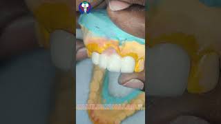 Anterior Teeth  PFM  Ceramic 4 Units  Upper Arch  Tamil Dental Lab  Dentist World  viralvideo [upl. by Asilla]