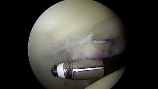 Articular Cartilage with a Grade 3 Injury to the Posterior Acetabulum near full thickness [upl. by Roselin]