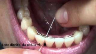 Como Passar Fio Dental no Dente com Aparelho  Orlando Tanaka [upl. by Yeruoc431]