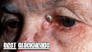 Reddit Top Pops Volume 3  Best Blackheads amp Dilated Pores [upl. by Seuqirdor]