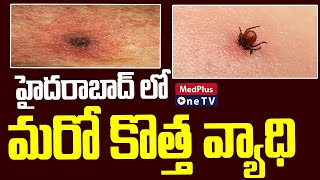 Scrub Typhus  New Disease in Hyderabad  MedPlusONETV [upl. by Enrobialc610]