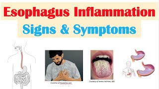 Esophagitis Esophagus Inflammation Signs amp Symptoms amp Why They Occur [upl. by Platto23]