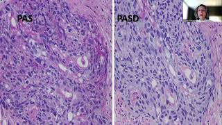 Tip48Gastric Adenocarcinoma with Enteroblastic Differentiation [upl. by Cinda]