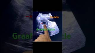 Graafian Follicle infertility pregnancyjourney ultrasound yt baby ytshorts short pcod yt [upl. by Elvie]