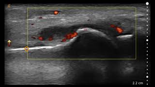 Image Interpretation 1st Metatarsophalangeal MTP [upl. by Meuse230]