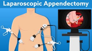 Laparoscopic  Appendix Removal Surgery  Appendectomy Instruments  Complications of Appendectomy [upl. by Heathcote]