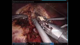 ROBOTIC ANATOMICAL RIGHT HEPATECTOMY AND DISTAL PANCREATECTOMY FOR OLIGOMETASTATIC PANCREAS ADENOCAR [upl. by Edorej458]