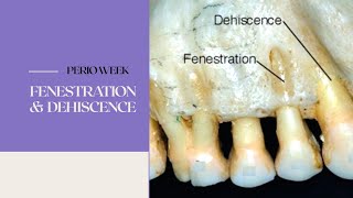 PERIO WEEK 📚  FENESTRATION amp DEHISCENCE [upl. by Marbut]